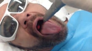 laser treatment for snoring