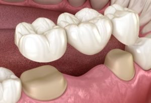 types of dental bridge