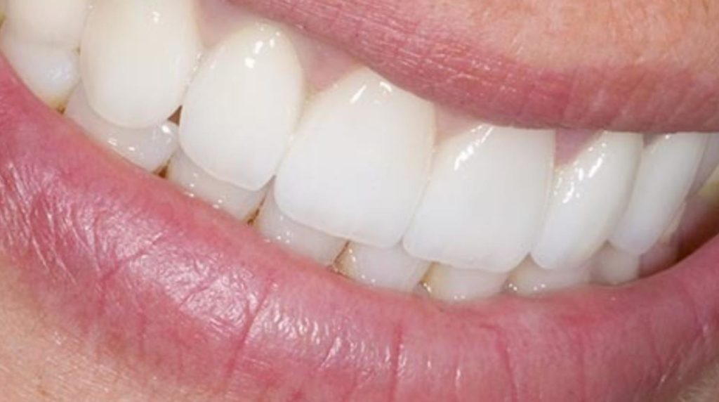 Dental Bridge 4 Types, Benefits, Use Case and Costs TMJ and Sleep