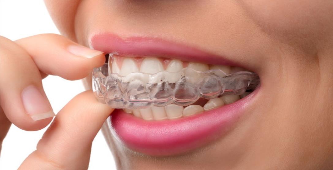 mouthguard for teeth grinding